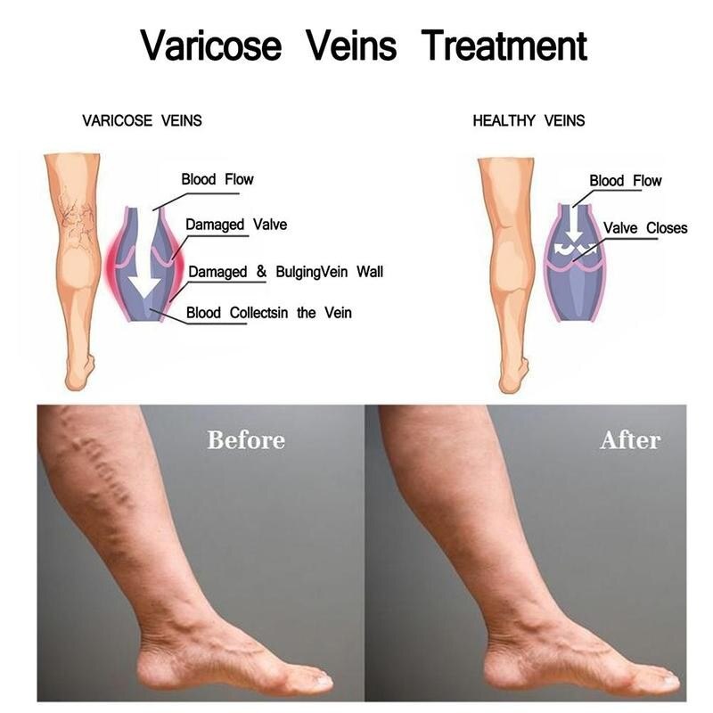 Varicose Veins Spray Cream