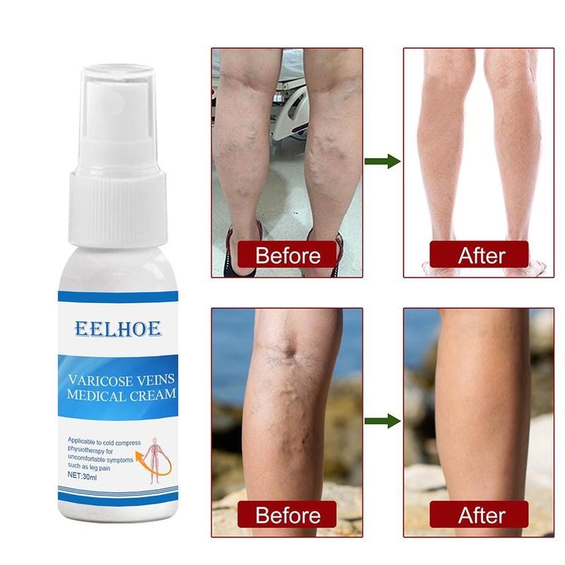 Varicose Veins Spray Cream